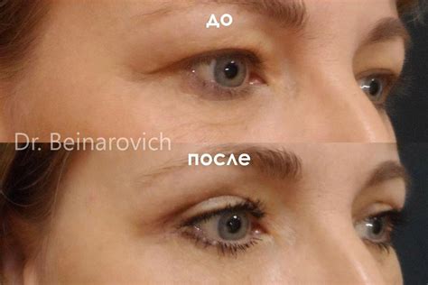 Круговая блефаропластика. Стоимость операции блефаропластика верхних и ...