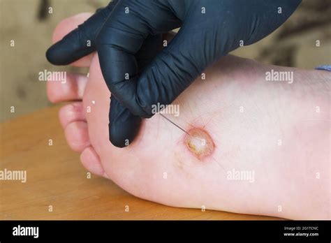 Dyshidrotic Eczema Feet