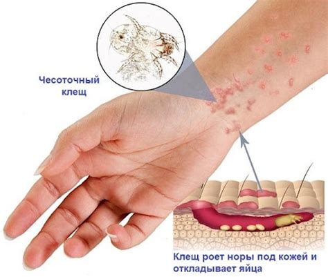 Чесотка: причины заражения и лечения | Медицинский центр Urosvit