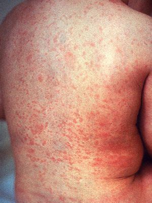 Pin on Medical: Skin Rashes