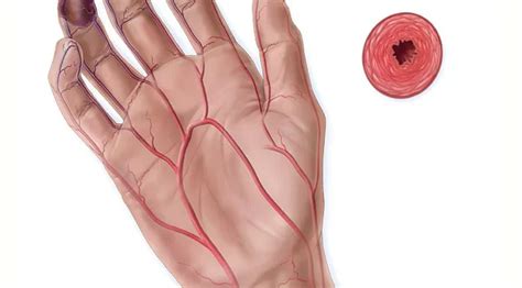 Buerger’s Disease - Medpath