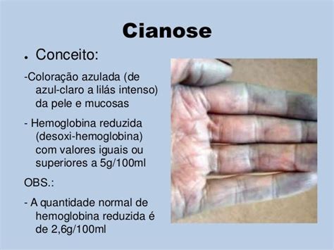 O Que Significa Cianose