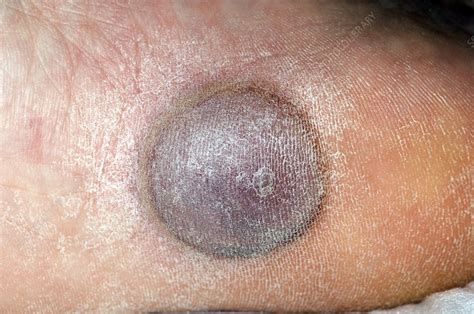 Plantar Wart Removal After Freezing | Bruin Blog