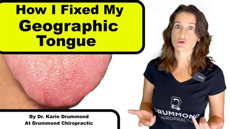 geographic tongue, remedy for geographic tongue