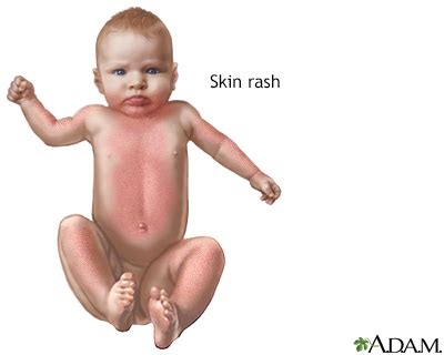 Rubella Information | Mount Sinai - New York