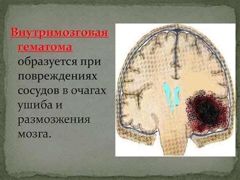 Гематомы головного мозга - презентация онлайн