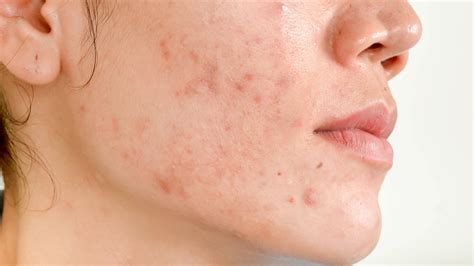 Very Mild Acne Scars