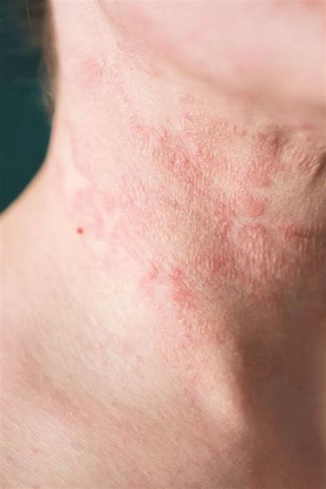 Acute Dyshidrotic Eczema: Causes, Symptoms, and Treatment