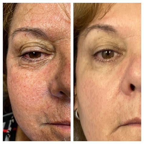 full face fibroblast before and after 1