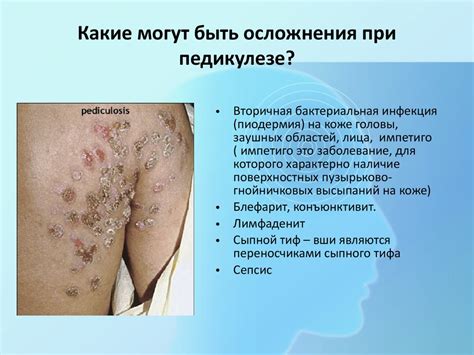 Педикулёз - презентация онлайн