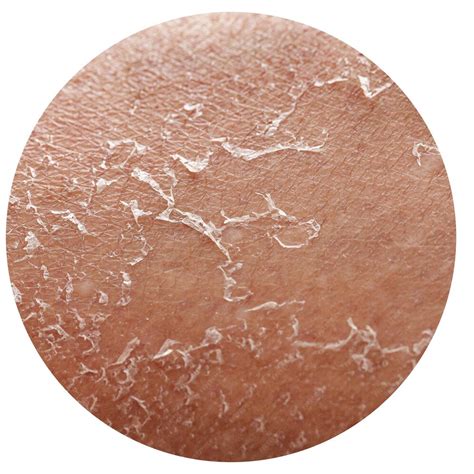 Melhor Tábua De Passar Roupa Tramontina - Detalles de la piel seca de una mujer Exfoliación después de la ...