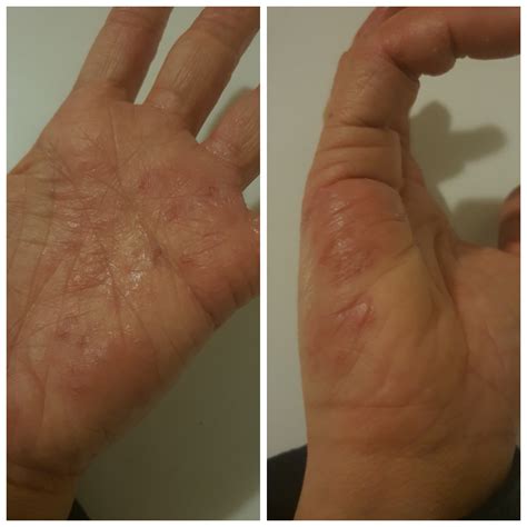 dyshidrotic dermatitis symptoms   treatment shti