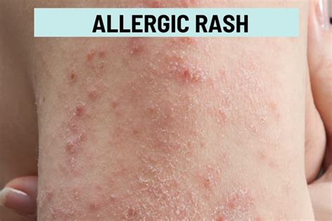 Itchy Rash On Skin Causes at Herman Stpierre blog