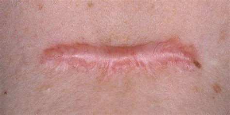 Scar Skin