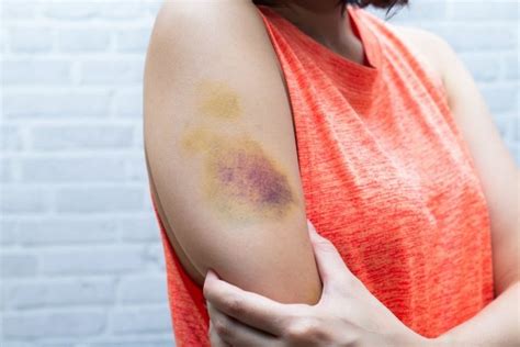 Какую опасность для здоровья может представлять гематома? | MedAboutMe
