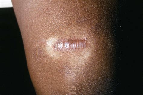 keloid scar keloids hypertrophic scars dermatology sydney