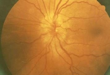 Papilledema Pictures, Symptoms, Causes, Treatment