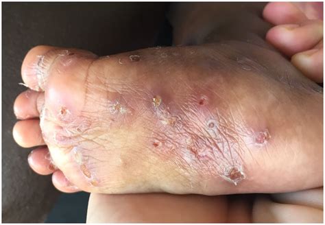Mild Scabies On Legs