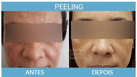 Peeling Rosto Antes E Depois