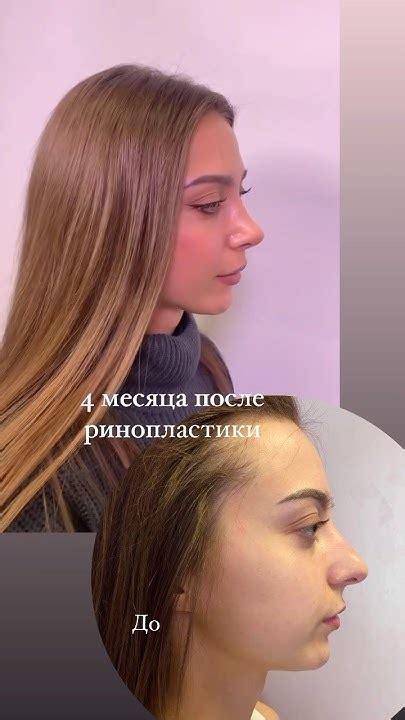 Результат закрытой ринопластики спустя 4 месяца после операции - YouTube