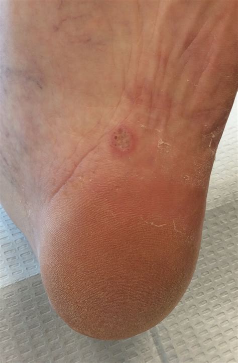 Athlete S Foot
