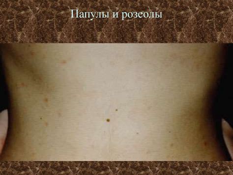 Вторичный период сифилиса - презентация онлайн