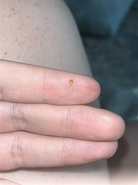 popped this from the back of my calf. i’ve never had a blackhead like