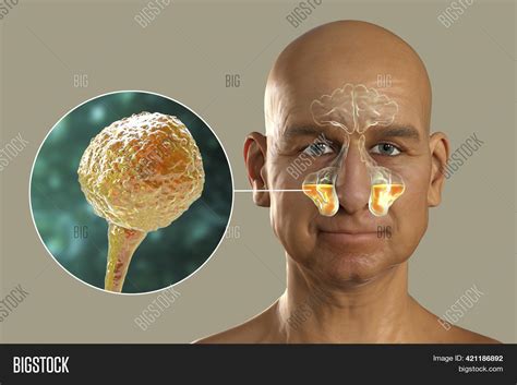 Mucor Fungi Cause Image & Photo (Free Trial) | Bigstock