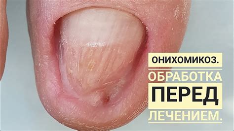 Медицинский педикюр. Аппаратная обработка ногтей. Онихомикоз. - YouTube