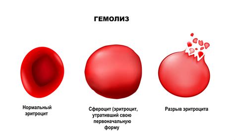 Гемолитическая болезнь плода - причины появления, симптомы заболевания ...