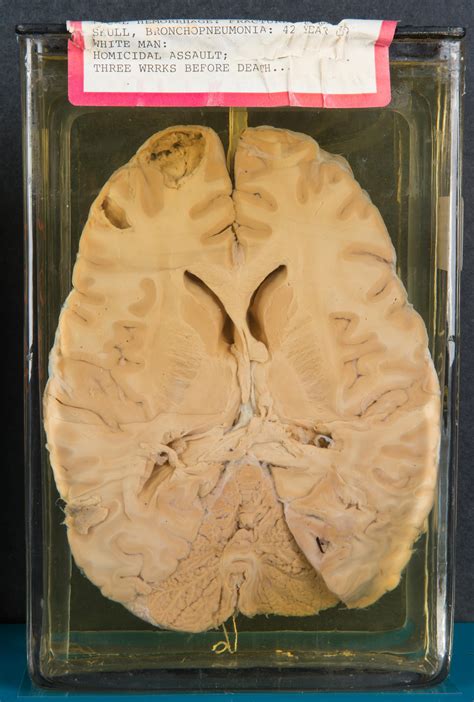 National Museum of Health and Medicine (NMHM): A Fragile Organ: The Brain