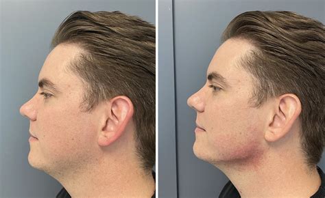Juvéderm Volux: The New Filler That Transformed This Man's Jawline 