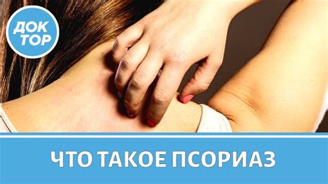 Как жить с диагнозом псориаз - YouTube