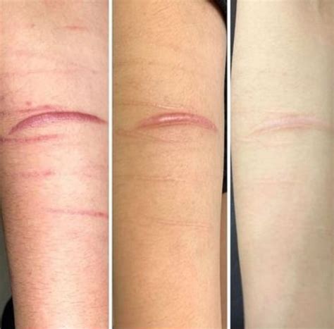 harm scars