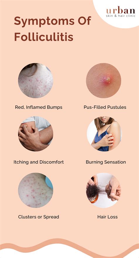 Folliculitis Types, Causes, Symptoms & Treatment | USHC
