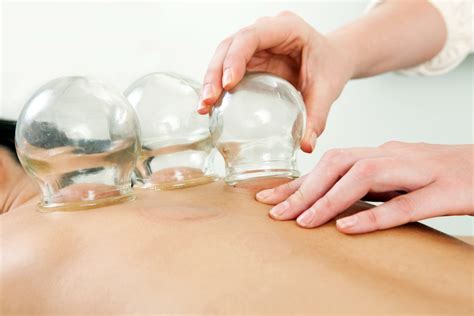 Cupping Singapore | Oriental Remedies