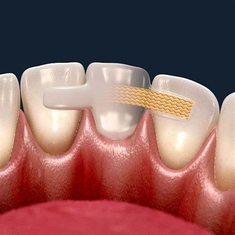 Шинирование зубов: что это и зачем делать? | Стоматология Atlantis Dental