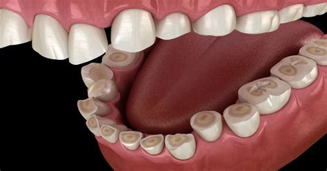 Damege Resulting from Teeth Clenching or Grinding