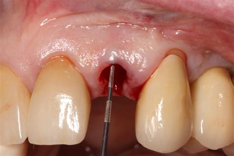 Why we should assess gingival phenotypes in daily practice – gingival ...