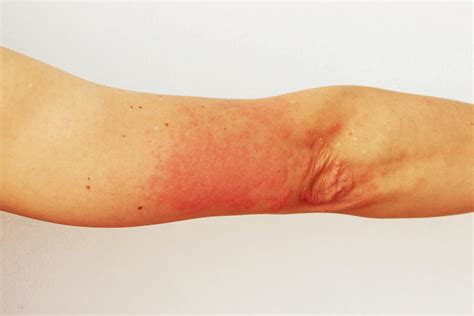 sun poisoning kill