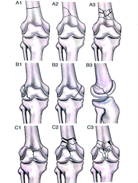 Distal Femoral Fractures: Complications and How to Avoid them? – Trauma International