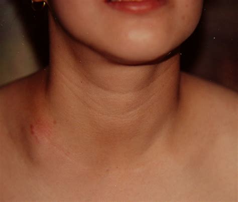 Neck 0729 Scrofula 1 | Surgery Photos