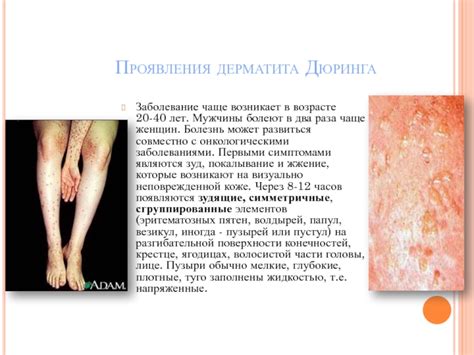 Болезнь Дюринга ( герпетиформный дерматит), многоформной экссудативной ...