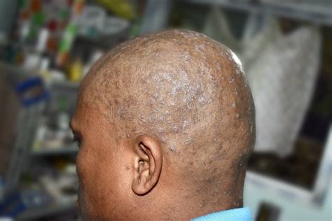 Tinea Infection at Scalp. it is a Fungal Infection that Causes Scaly ...