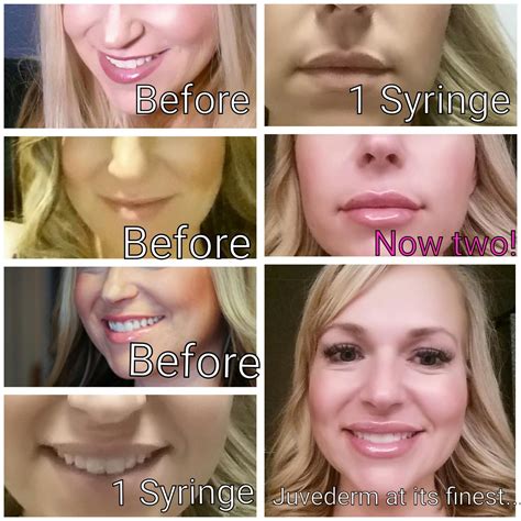 Juvederm Syringes at Ann Fairley blog
