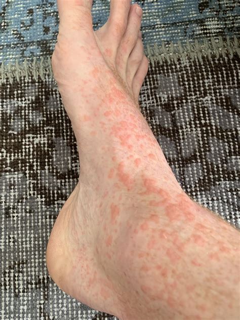 Feet Rash Red at Evelyn Sanchez blog