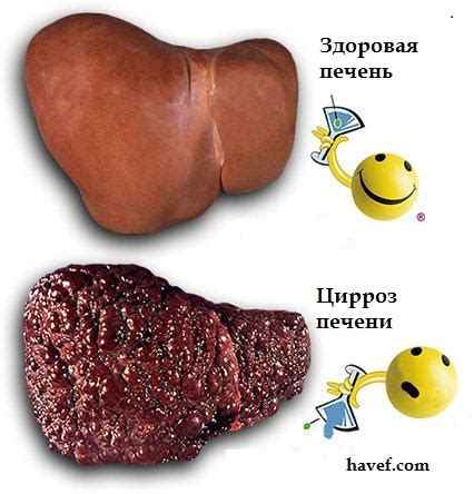 Питание при циррозе печени - что рекомендуется, а что нет