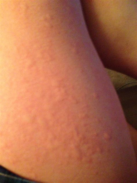 Postpartum hives? — The Bump