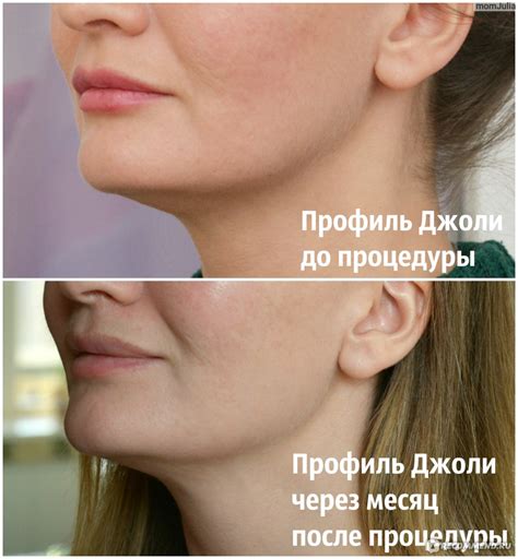 Углы Джоли До И После - HD фотoграфии