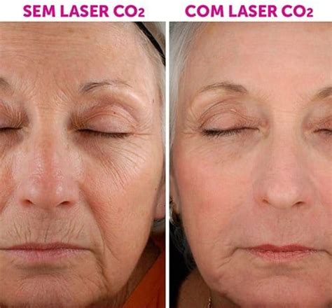 Antes E Depois Do Laser No Rosto - Depilacao A Laser Antes E Depois Do Rosto